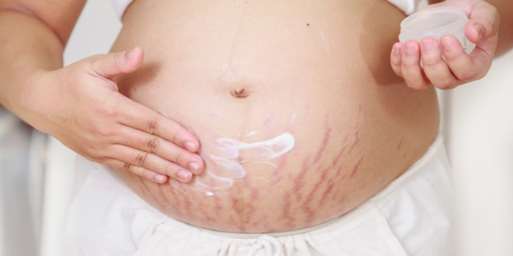 En Etkili Gebelik Çatlak Kremleri