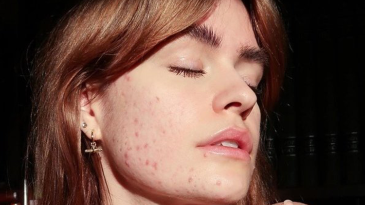 Akne Nedenleri ve Oluşum Süreci Nasıldır?